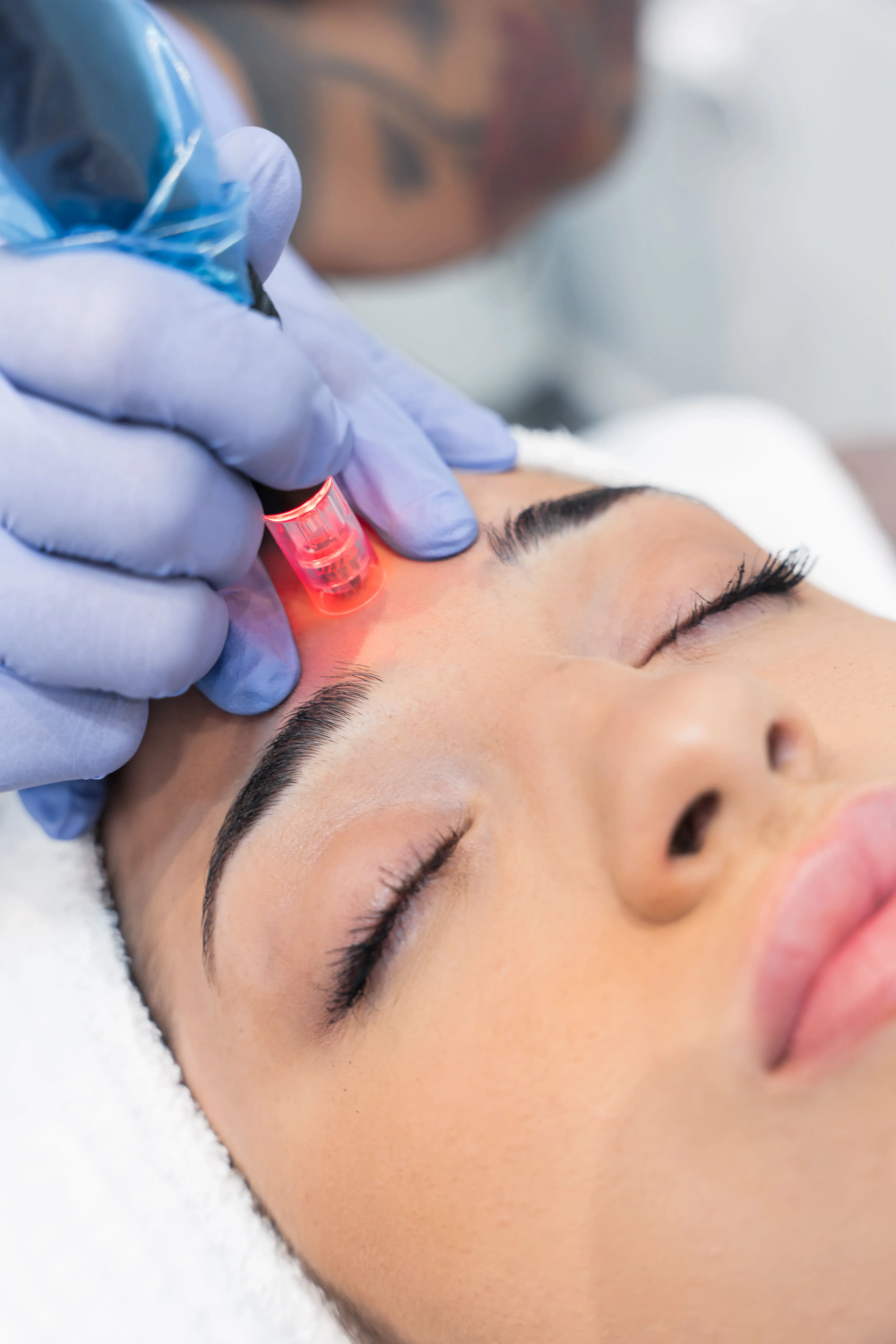 Microneedling Facial by Mesoestetic
