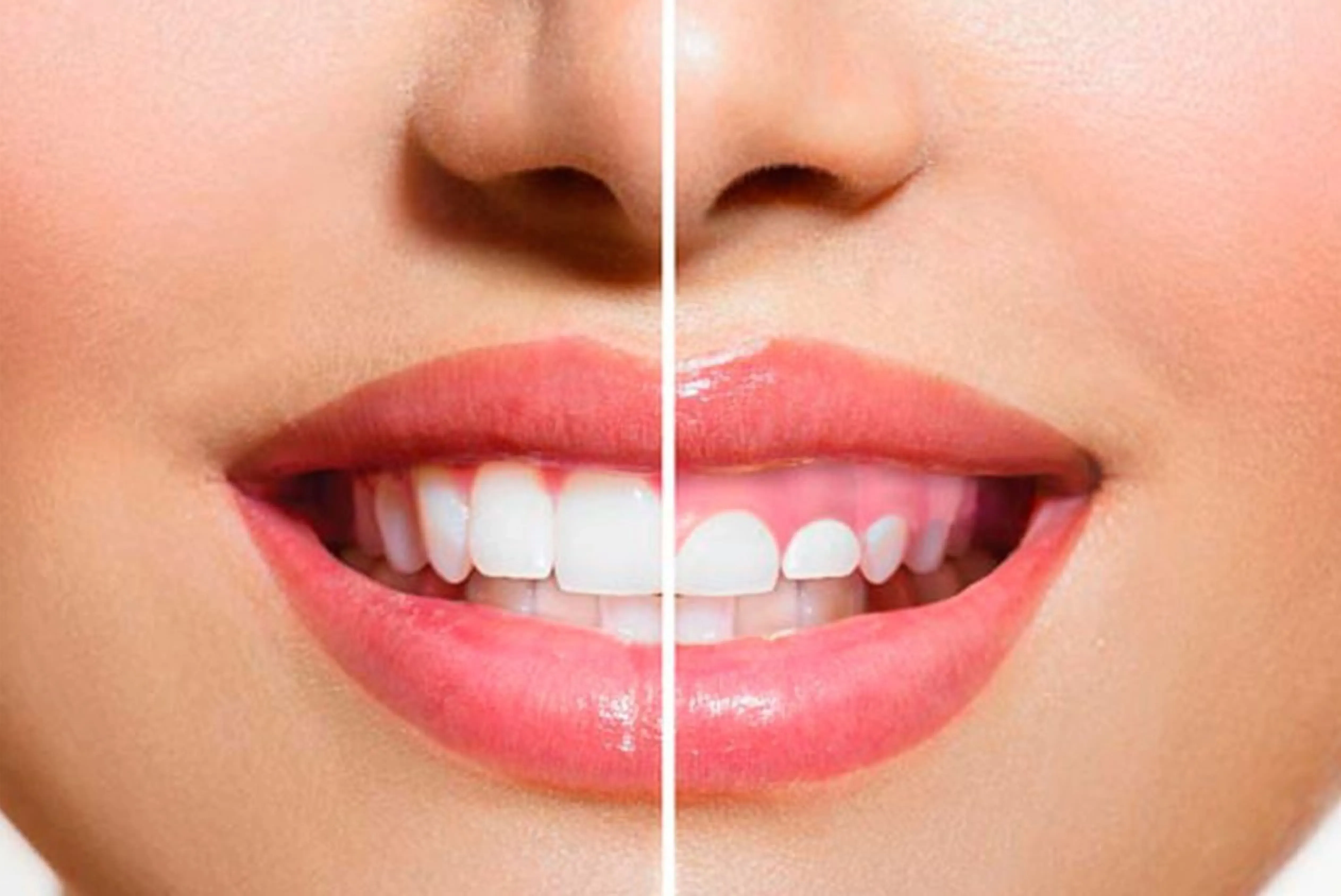 Corrección de sonrisa gingival