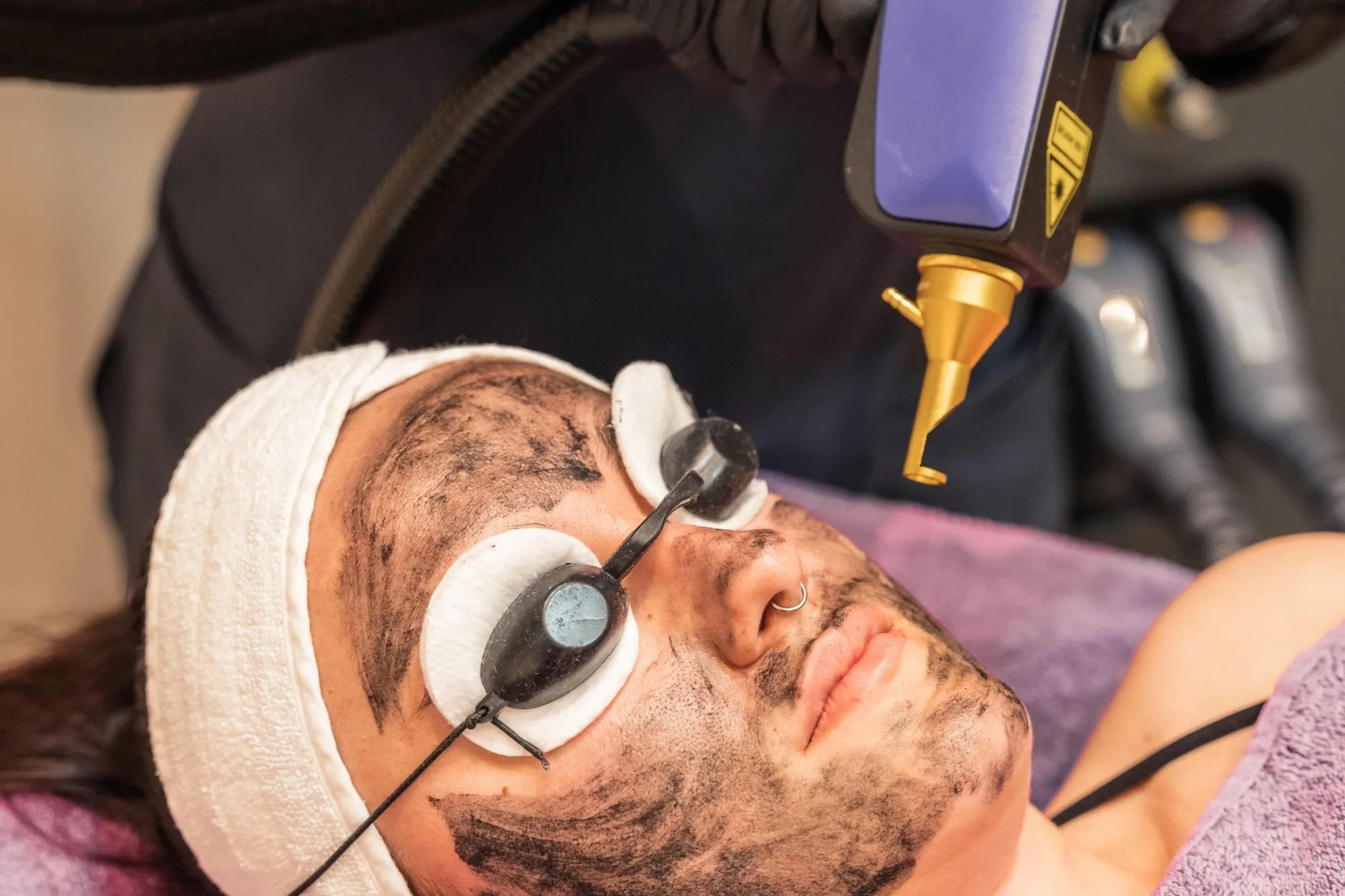 Carbon Peel (Hollywood Peel)