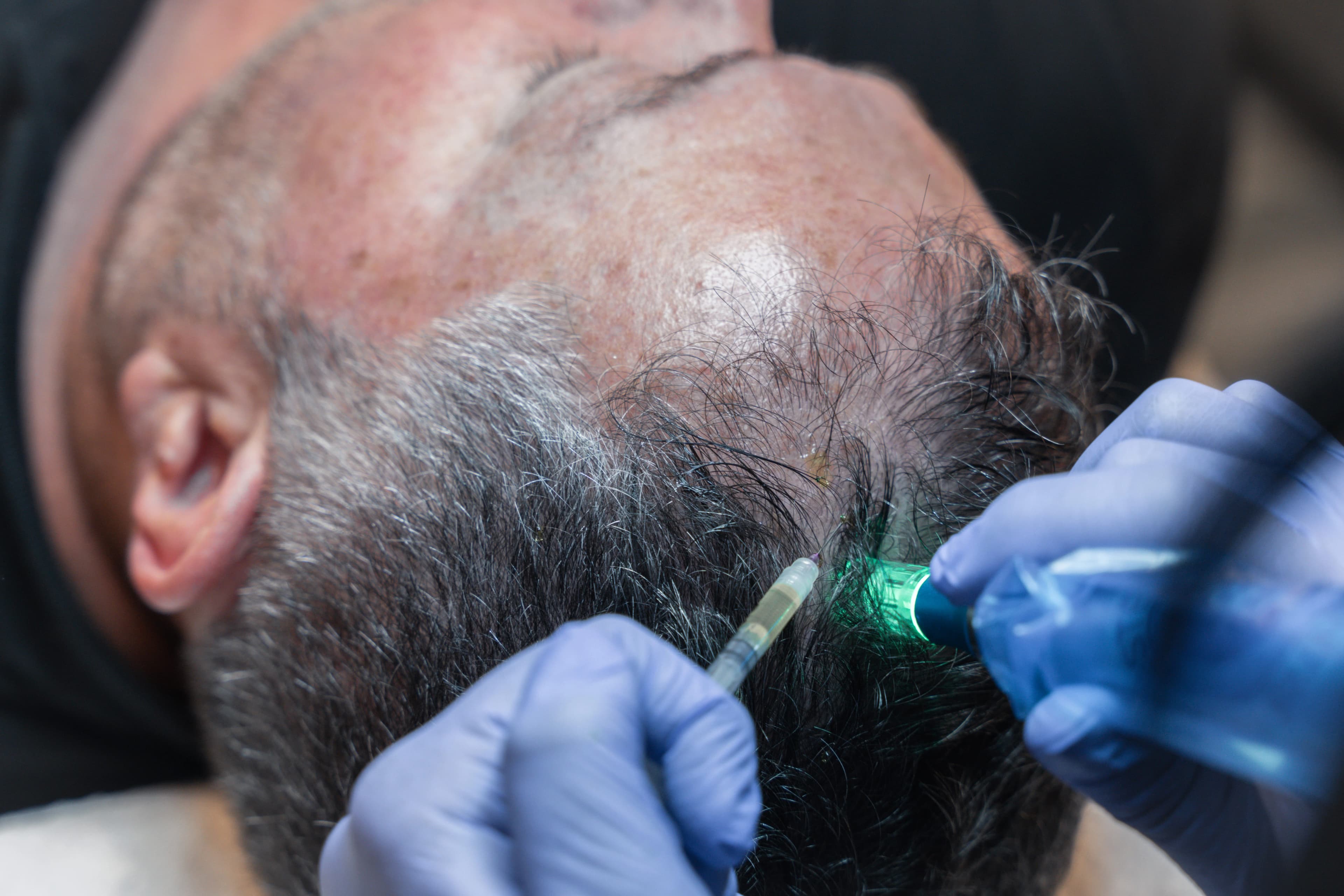 Microneedling Capilar by Mesoestetic