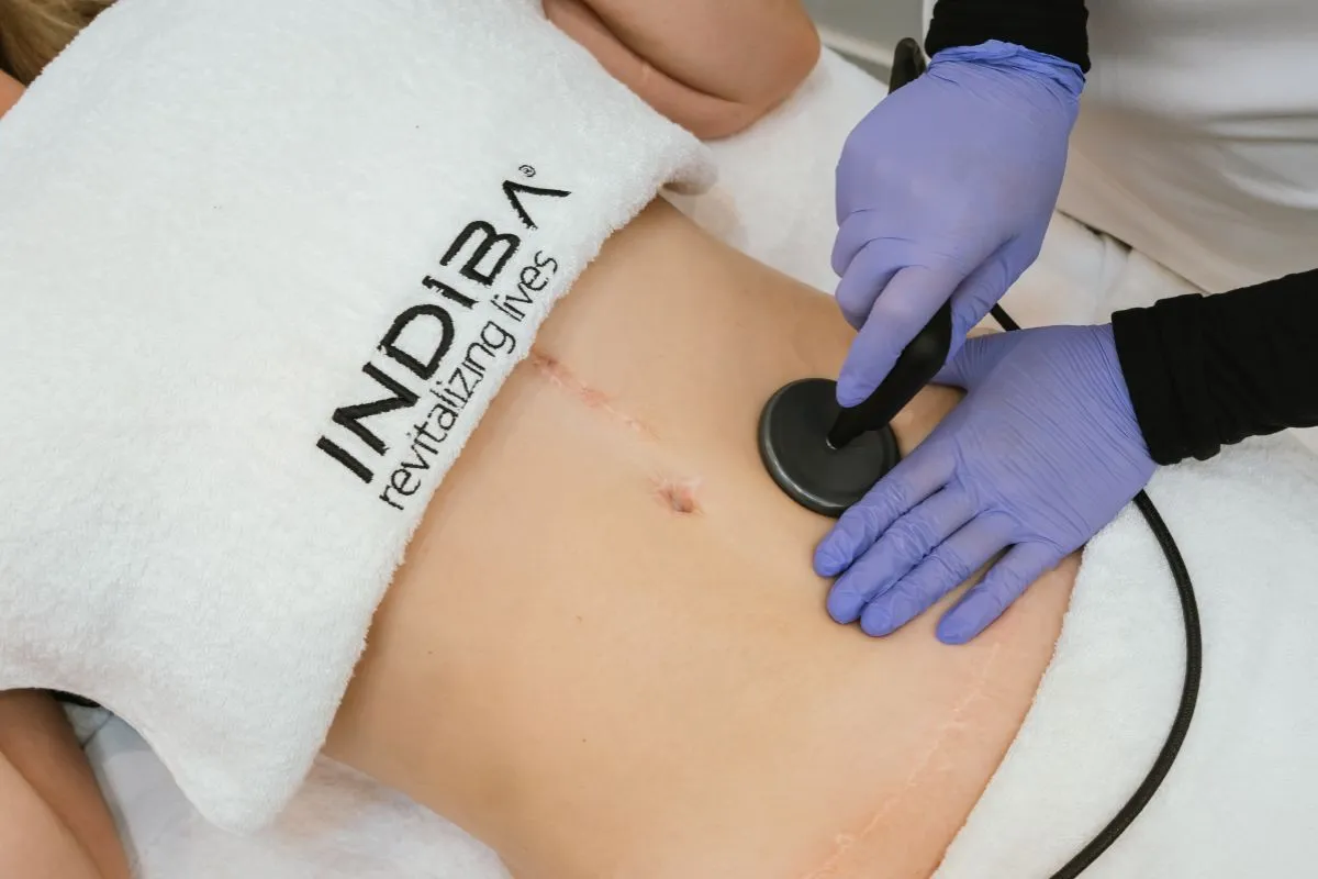 Tratamiento con INDIBA en un abdomen con cicatrices quirúrgicas